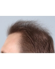 Before Hair Transplant&nbsp;2 Sessions (Areas)